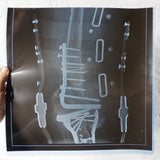 Vintage Genuine Medical X-Ray 14X14" of a Fractured Knee with Multiple Medical Screws, Surgical Plates and Straps, Human Skeleton