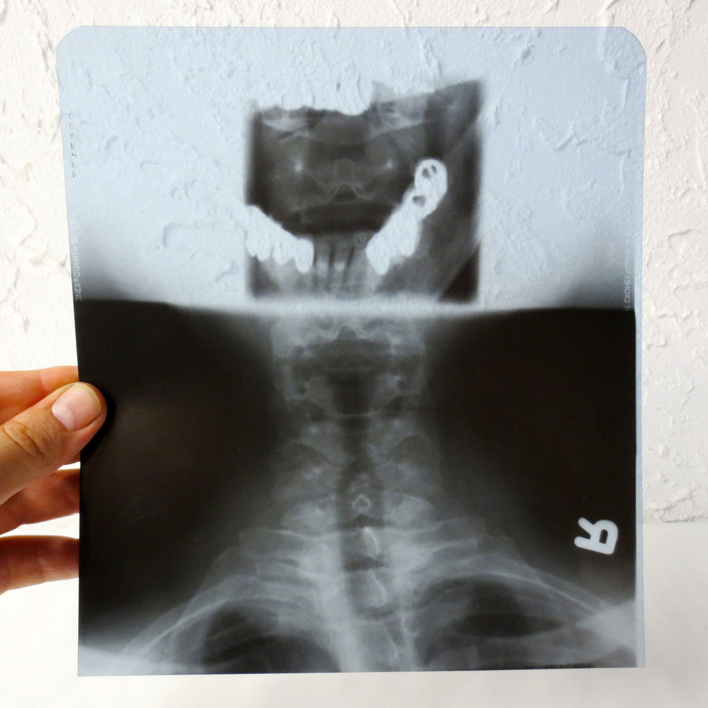 Vintage Genuine Medical X-Ray 8X9" of a Patient's Neck Cervical Vertebrae and Open Jaw, Human Skeleton X-Ray, Thick Blue Plastic Sheet